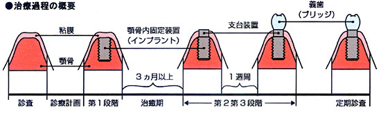 インプラント概要