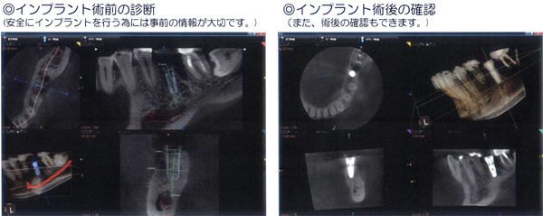 インプラント術前の診断とインプラント術後の確認