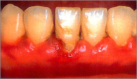 歯周病の歯写真